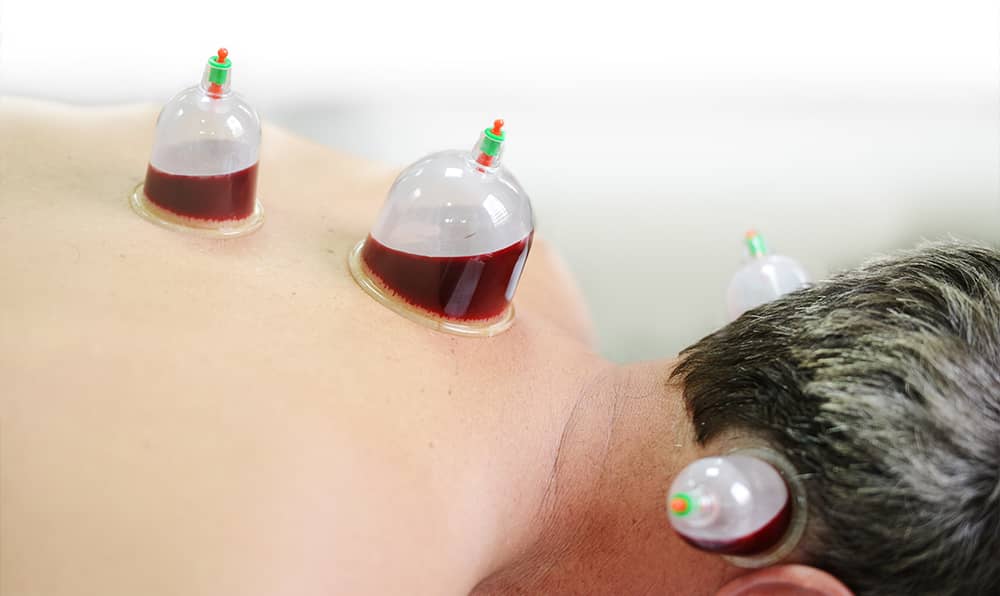 حجامة لعلاج الصداع